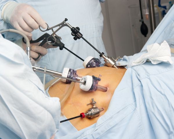 laproscopy surgery in janakpuri