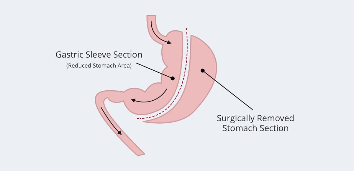 Bariatric Surgery