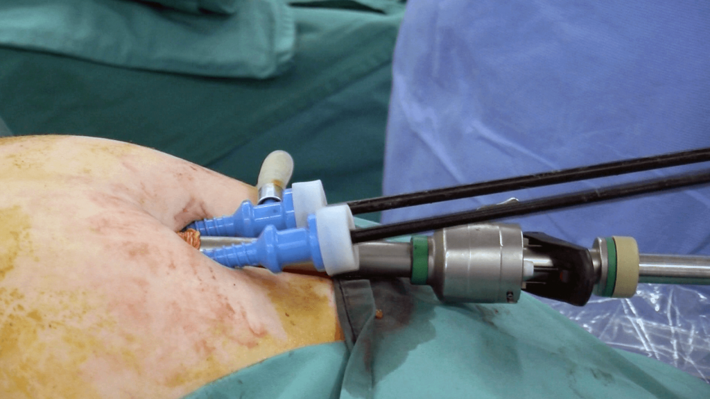 Single Incision Laparoscopic Surgery (SILS)