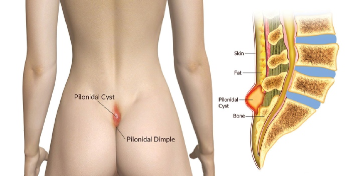 Pilonidal Sinus treatment