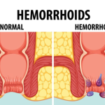 Piles, Fissures & Fistulas: What’s the Difference & How Are They Treated?